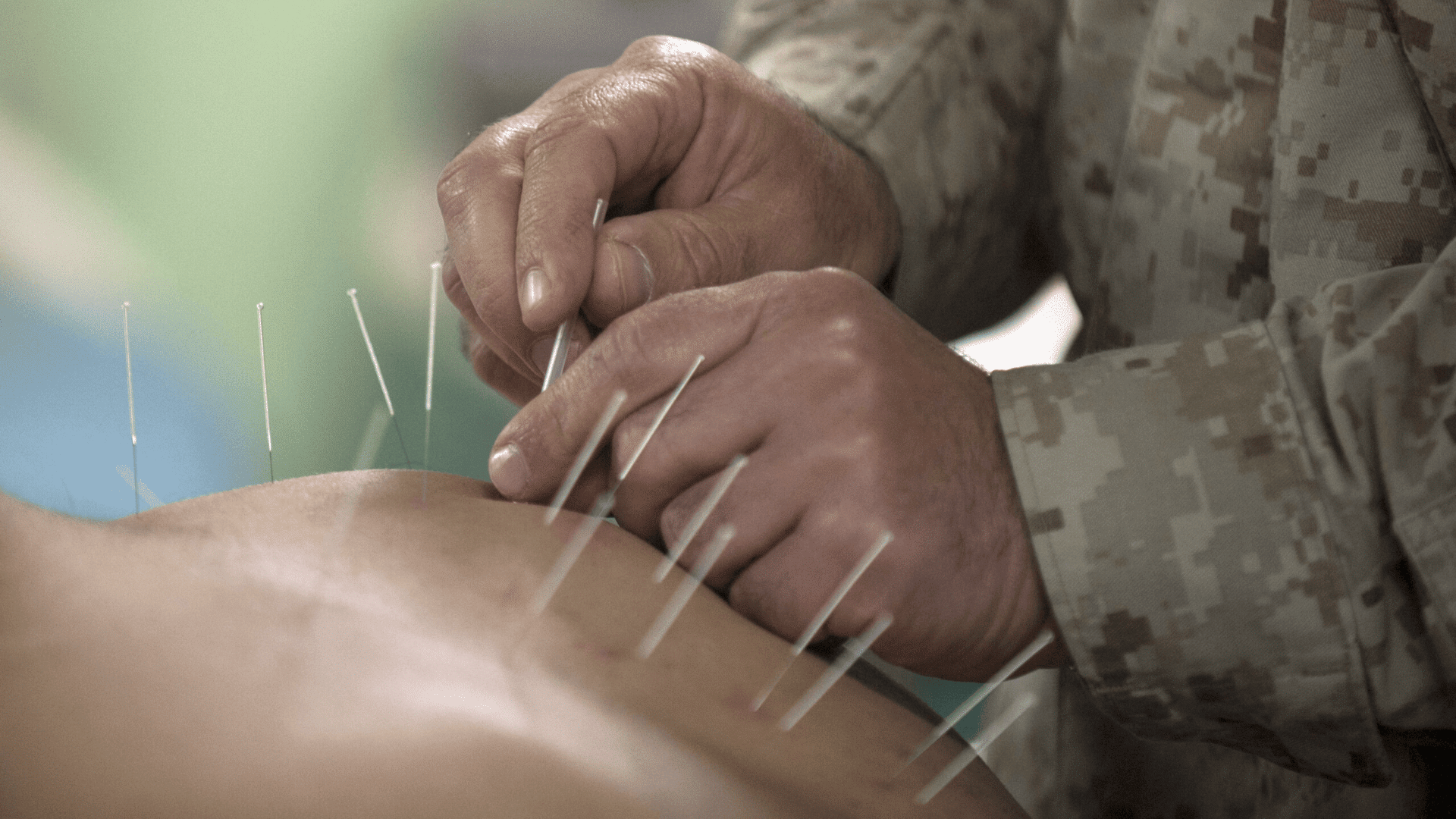 acupuncture-benefits-top